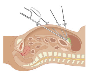 Minimal Invasive Surgery, Laparoscopic Surgery.