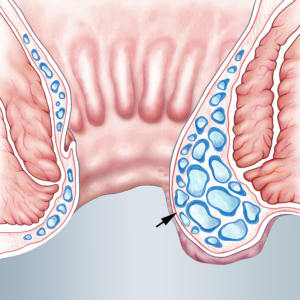 Haemorrhoids Horstmann Todoroff
